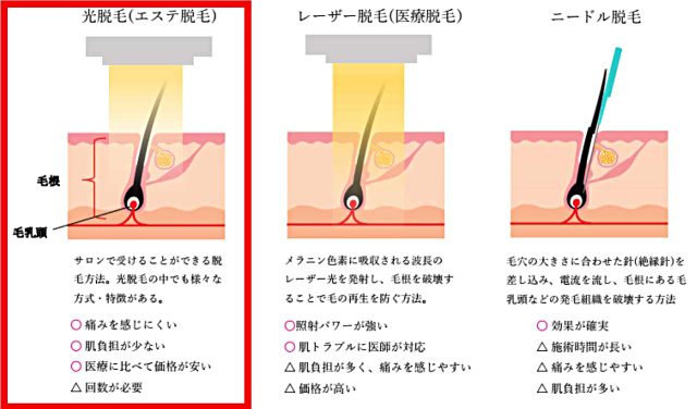 脱毛の種類を比較